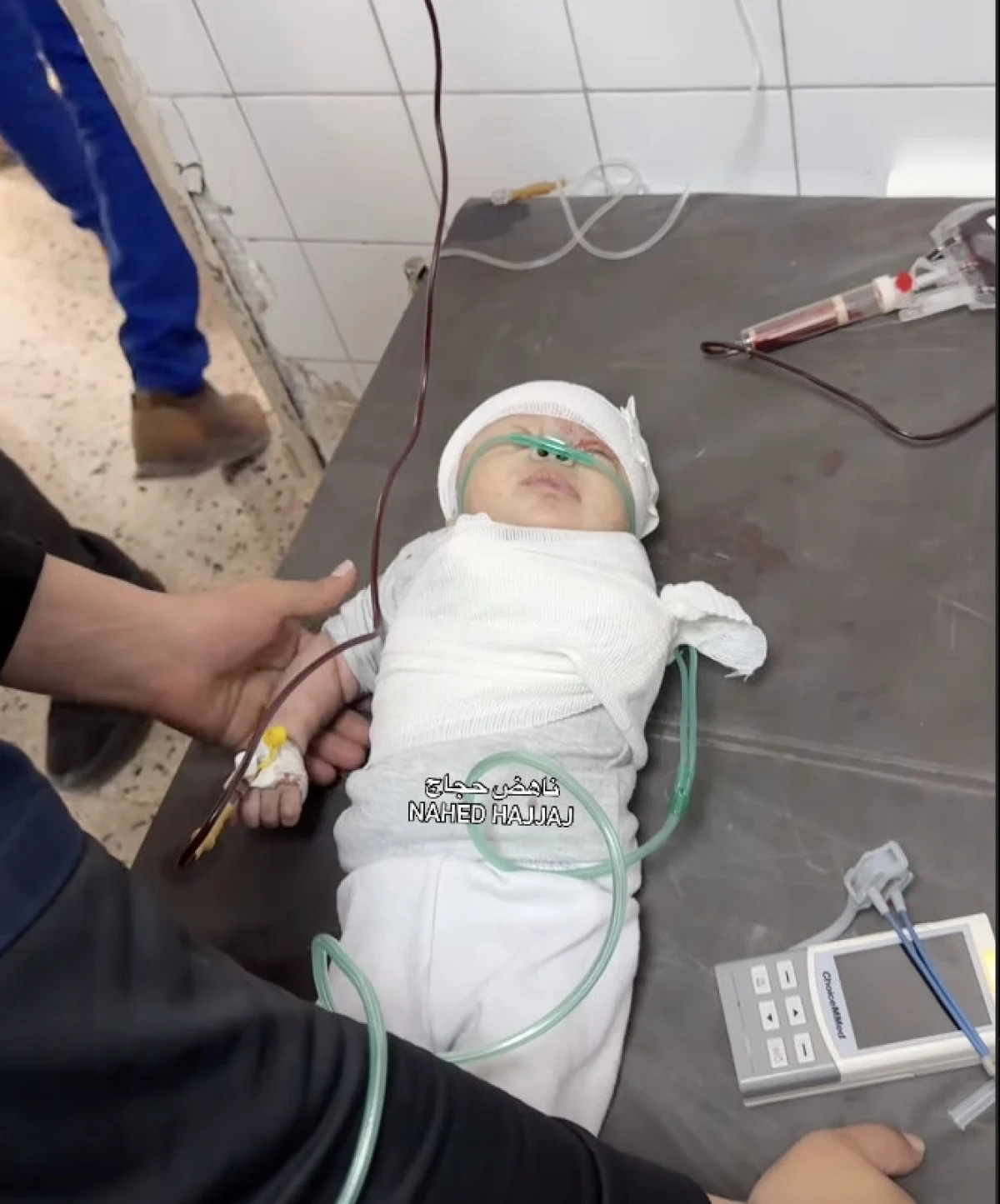 Gazze’de Minik Bir Bebeğin Dramı: İsrail Saldırısında Kolu Koptu